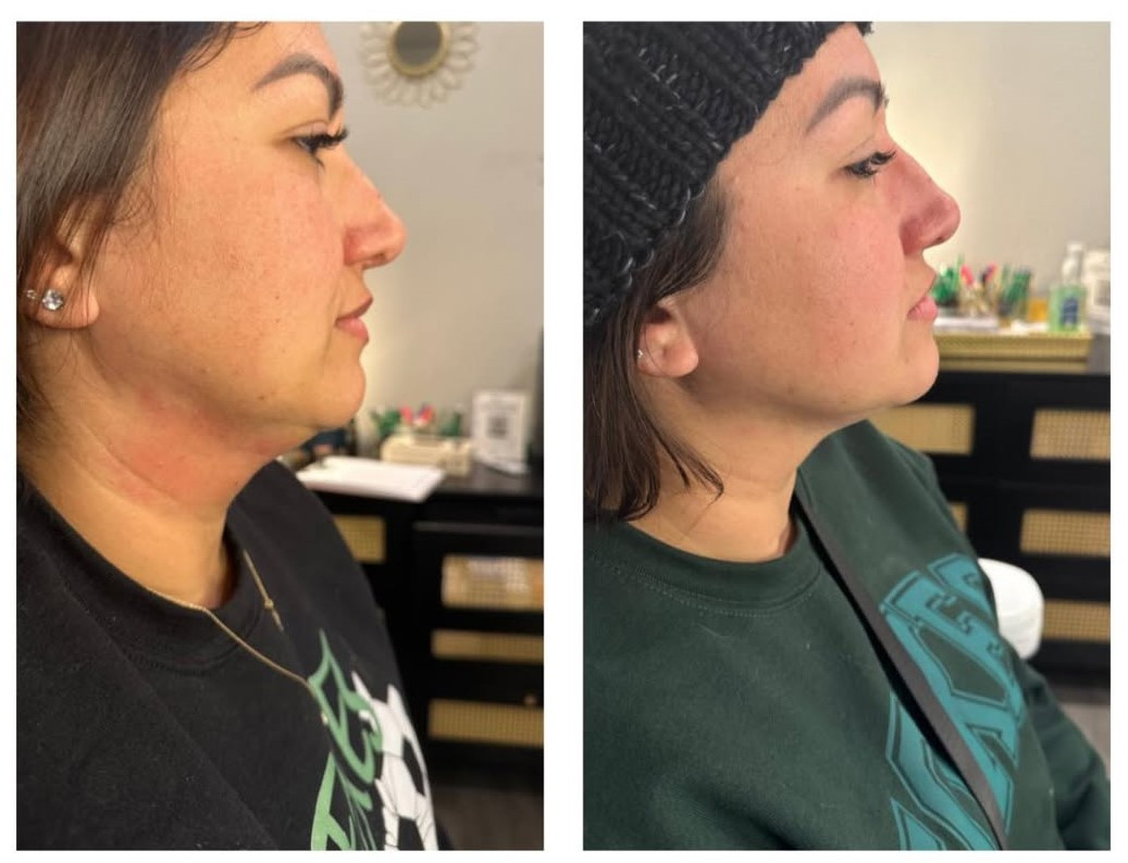 PCDC fat-dissolving injections for non-surgical body contouring